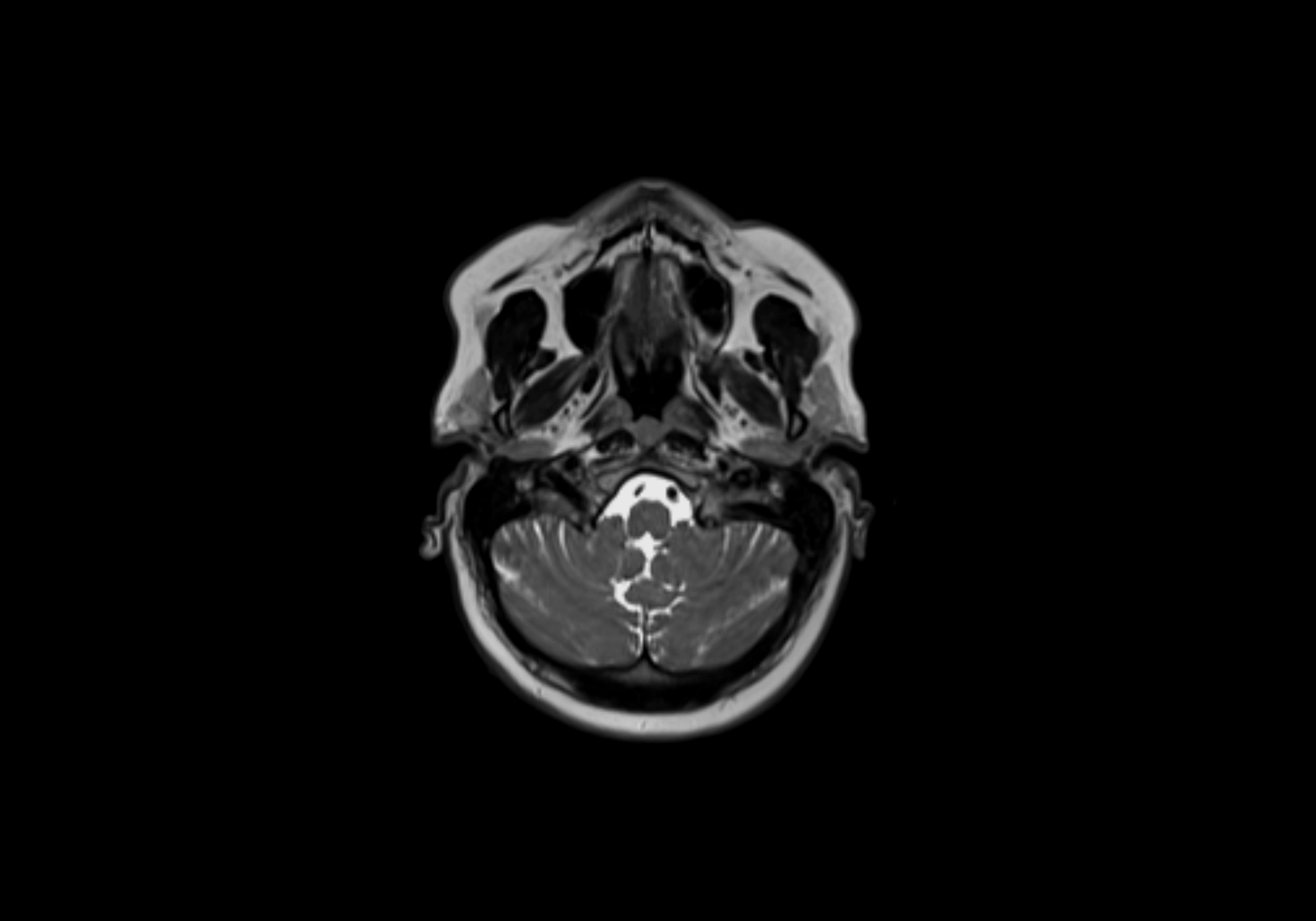 Neck axial  lymph node cross sectional MRI anatomy 3T MRI  image-img-00001-00023.webp